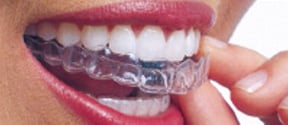 invisalign img1