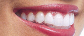 invisalign img2